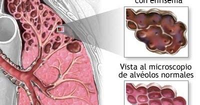 ¿Que es enfisema Pulmonar?