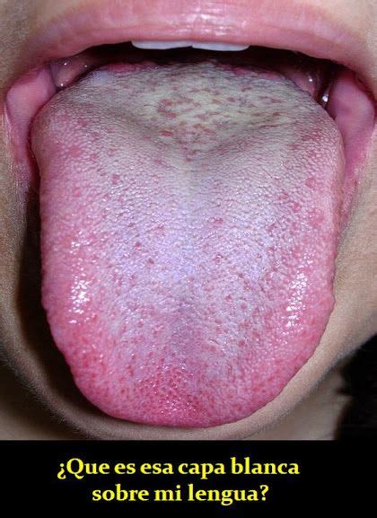 ¿Que es esa capa blanca sobre mi lengua? | OdontoFarma ...