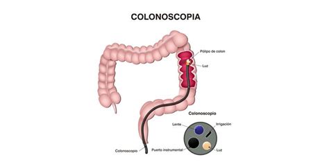 ¿Qué es la colonoscopia? | CuidatePlus