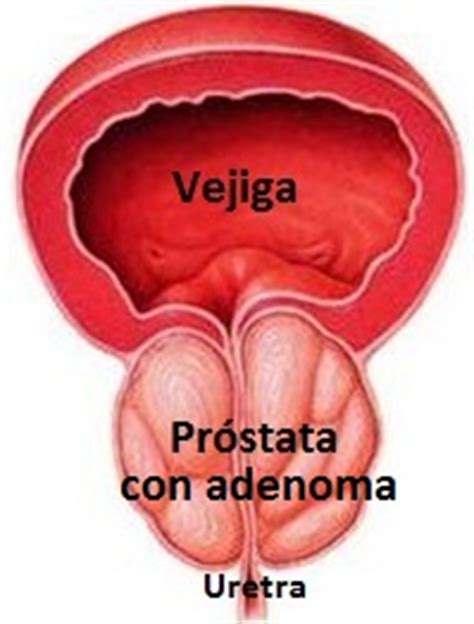 ¿Qué es la Hiperplasia Benigna o Adenoma de Próstata  HBP ?