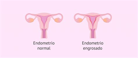 ¿Qué es la hiperplasia endometrial y por qué se produce?