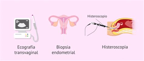 ¿Qué es la hiperplasia endometrial y por qué se produce?
