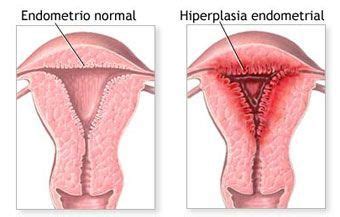 ¿Qué es la hiperplasia endometrial? ¿Es grave?   Tu Ginecologa