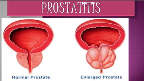 ¿Qué es la prostatitis?   Unidad Privada de Urologia