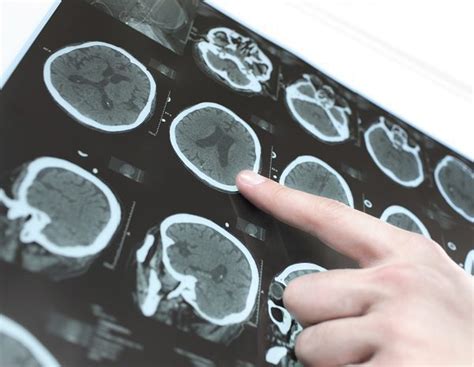 Qué es un derrame cerebral y por qué se produce   Bekia Salud
