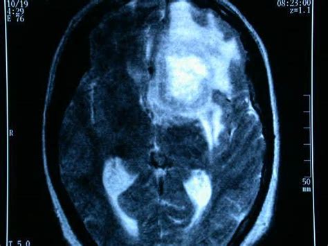 ¿Qué es un Glioma? | Unidad de Neurocirugía RGS