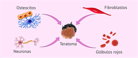 ¿Qué es un teratoma?   Definición, tipos, causas y síntomas