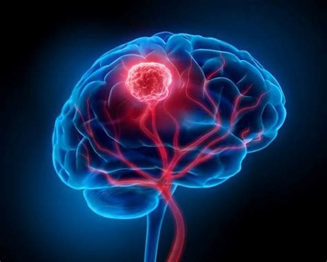 ¿Qué es un tumor cerebral? | Dr Camacho