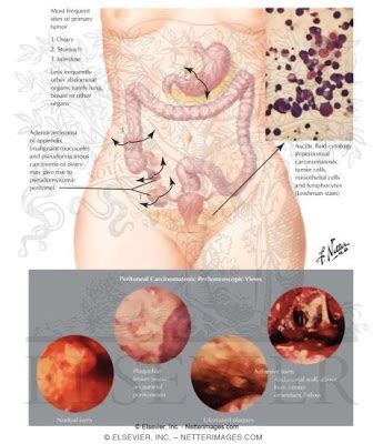 ¿Qué es una carcinomatosis peritoneal?