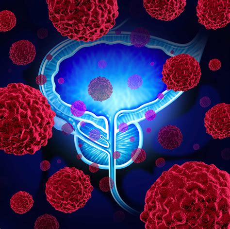 ¿Qué ocurre cuando se detecta un tumor en la próstata?   Clínicas ...