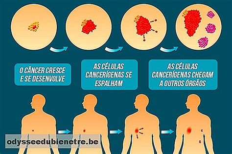 ¿Qué son las metástasis y dónde pueden surgir   es ...