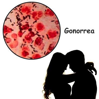 ¿Qué sucede si no se trata la gonorrea?, ¿Qué puede ...
