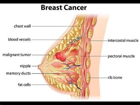 Quels sont les différents types de cancer du sein ?   YouTube