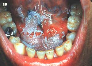 Queratosis benigna