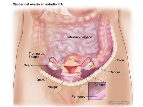 Quimioterapia intraperitoneal en cáncer avanzado de ovario ...
