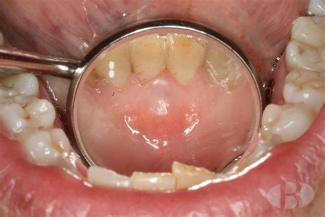 Quiste gingival del adulto » Clínica Dental Borrás
