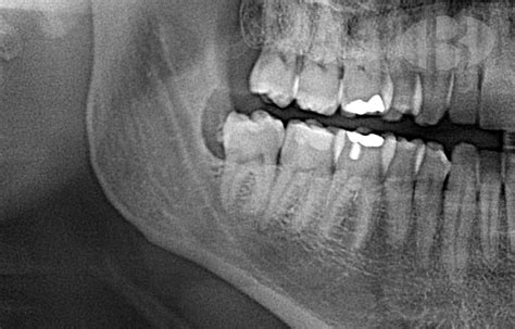 Quiste paradental asociado a un tercer molar inferior derecho con ...