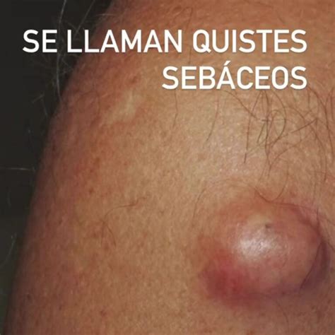 Quiste Sebáceo: Una bolsita de grasa en la piel   EF Medical Group