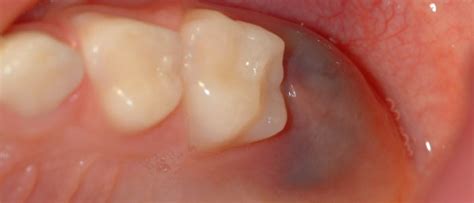 Quistes Dentales: tipos y tratamiento   Cuidado Dental ...