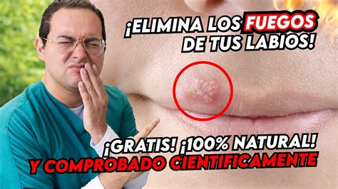 QUITA LOS FUEGOS DE TU BOCA Y LABIOS CON ESTE REMEDIO NATURAL RAPIDO Y ...