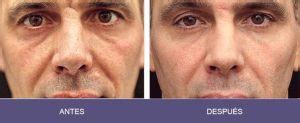 Radiofrecuencia Facial    Antes y Después  con FOTOS