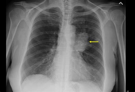 radiografía cáncer de pulmón   En Lucha contra el Cáncer
