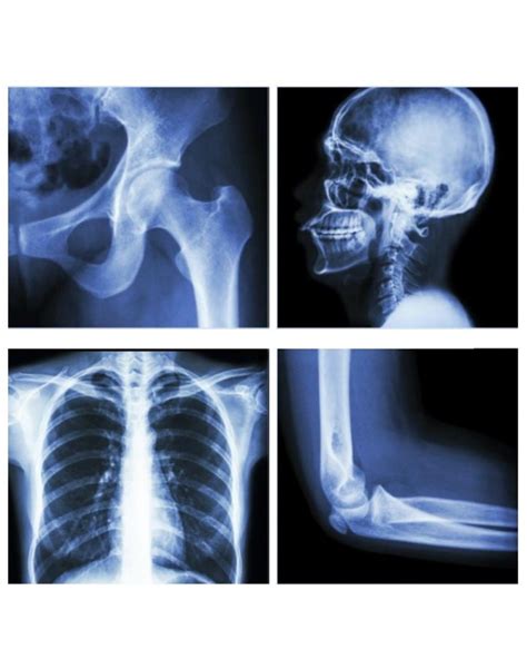 Radiografía de serie ósea metástasis