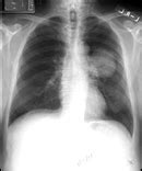 Radiografías para detectar precozmente el cáncer de pulmón – Venelogía