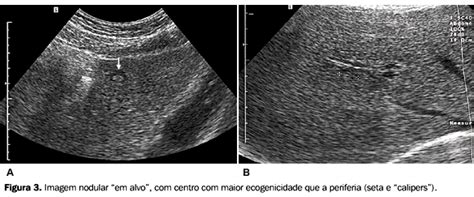 Radiologia Brasileira   Aspectos ultra sonográficos dos hamartomas dos ...