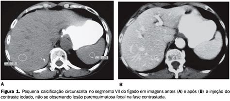 Radiologia Brasileira   Calcificações hepáticas: freqüência e significado