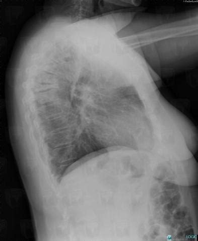Radiology case : Metastasis  X rays    Diagnologic
