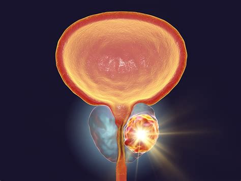 Radioterapia a tumor primario en cáncer de próstata ...