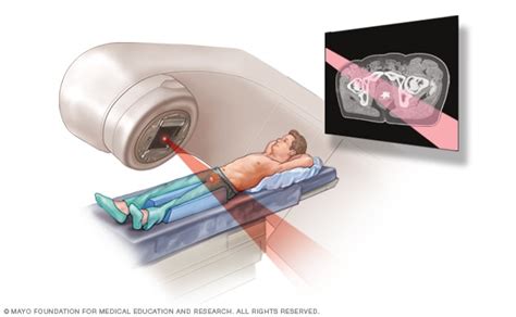 Radioterapia de haz externo para el cáncer de próstata Mayo Clinic