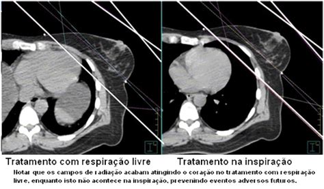 Radioterapia no tratamento do câncer  neoplasia  de mama ...