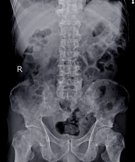 Rayos x impresión de la columna lumbar: metástasis óseas ...