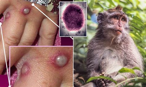 RD: Investigan chino con síntomas de viruela del mono | Remolacha ...