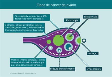 Recomeçar: O que é o Câncer de Ovário?