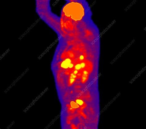 Rectal cancer and metastasis, PET scan   Stock Image ...