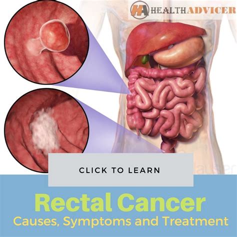 Rectal Cancer   Causes, Picture, Symptoms and Treatment