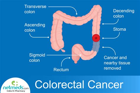 Rectal Cancer: Causes, Symptoms And Treatment | Netmeds