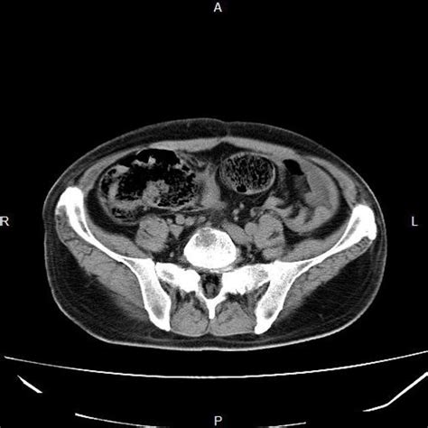 Rectal cancer | Radiology Case | Radiopaedia.org