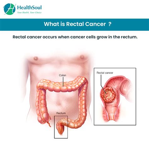 Rectal Cancer – Don t ignore the early signs ...