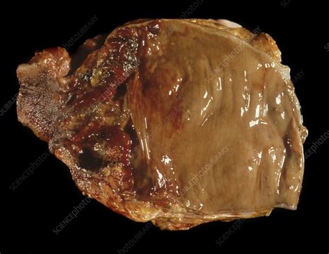 Rectal cancer   Stock Image   C022/7178   Science Photo ...