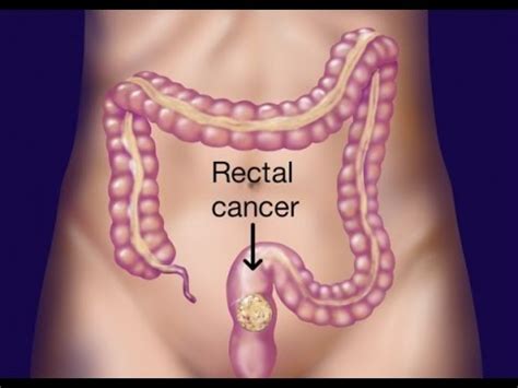 Rectal Cancer Symptoms   YouTube