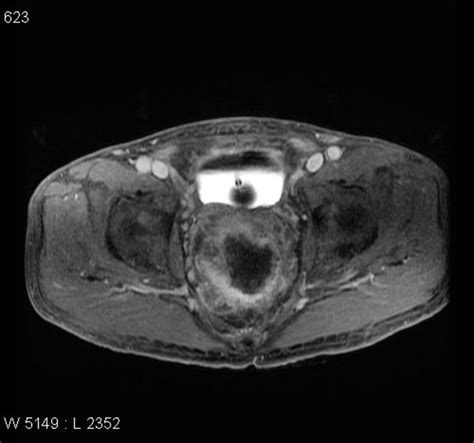 Rectal cancer   T4   invading into prostate | Radiology ...