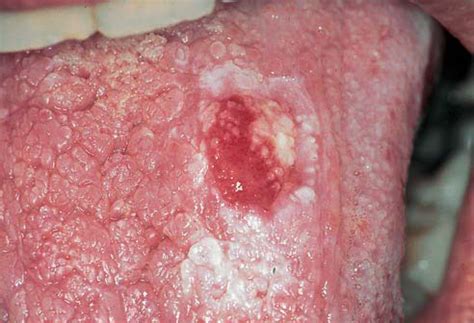 Red Lesions of the Oral Mucosa Differential Diagnosis ...