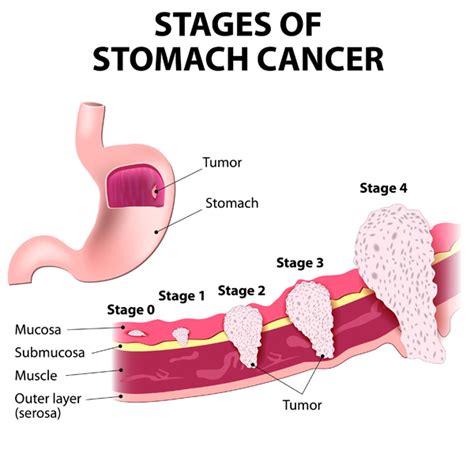 Reduce Your Risk Before Stomach Cancer Symptoms Develop ...