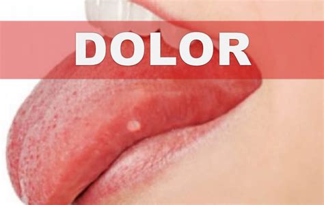 Remedios caseros para el dolor de lengua – Como aliviar el ...