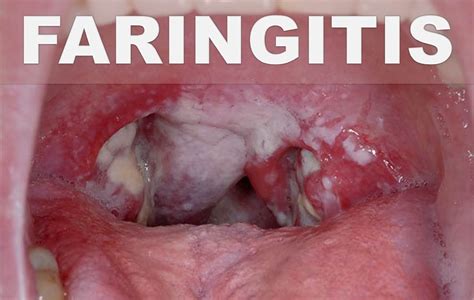 Remedios caseros para la faringitis estreptocócica – Dolor ...