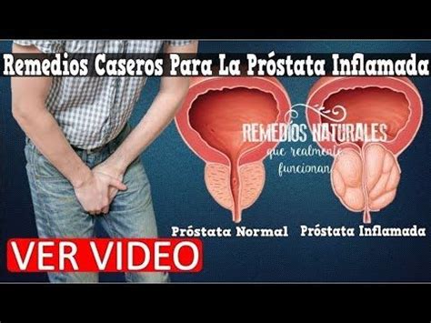 Remedios Caseros Para La Prostata Inflamada, Sintomas De Problemas De ...